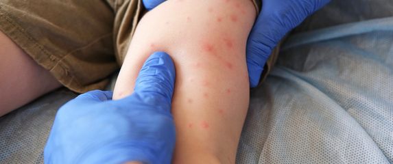 Ospice kod djece; Ilustracija