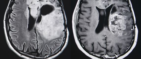 Tumor na mozgu, ilustracija