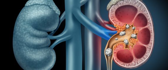 Bubrežni kamenci, ilustracija