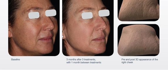 Prije i poslije tretmana laserom LUMENIS M22