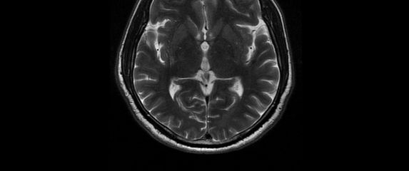 MRI mozga, ilustracija