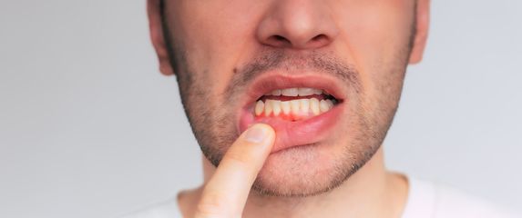 Upaljene desni, ilustracija