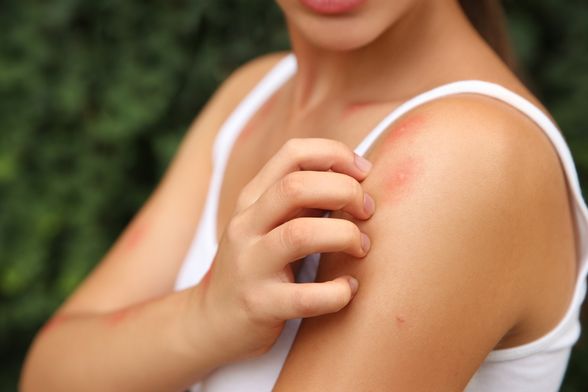 Ubod komarca jako svrbi i iritira