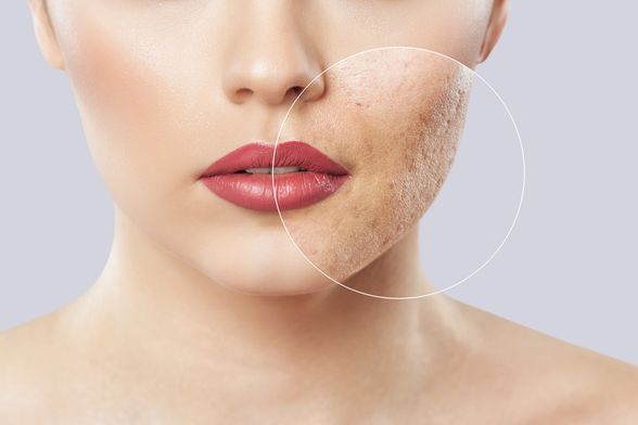 Kako riješiti akne u odrasloj dobi