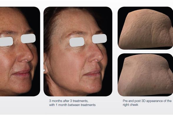 Prije i poslije tretmana laserom LUMENIS M22