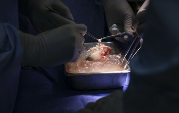 Transplantacija genetski modificiranog bubrega svinje