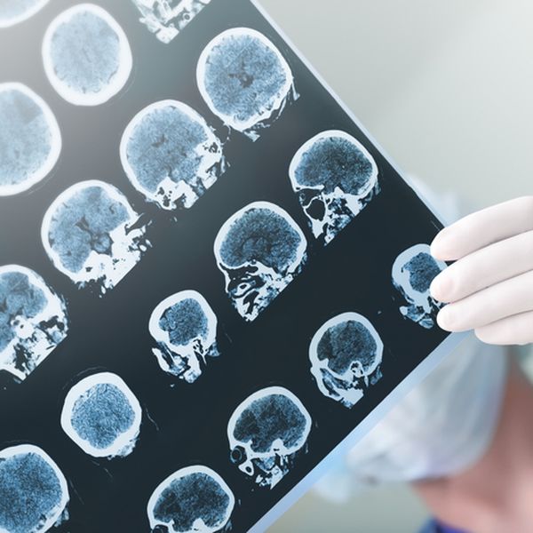 Pronašli lijek za okrutnu i razornu bolest od koje pate tisuće: Čak sam se malo rasplakao kad sam vidio rezultate!