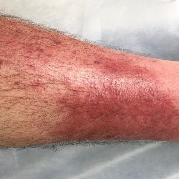 Celulitis: Simptomi koje mnogi ignoriraju – a mogu dovesti do ozbiljnih komplikacija