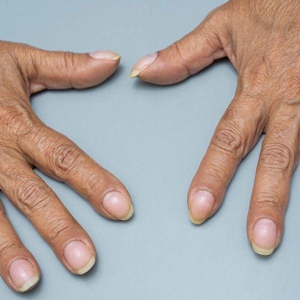 Batićasti prsti: Promjena na noktima koja može ukazivati na opasno stanje