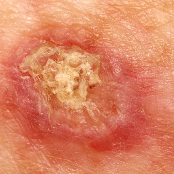 Planocelularni karcinom: Tihi rak koji počinje kao bezazlena ranica – prepoznajte ga na vrijeme