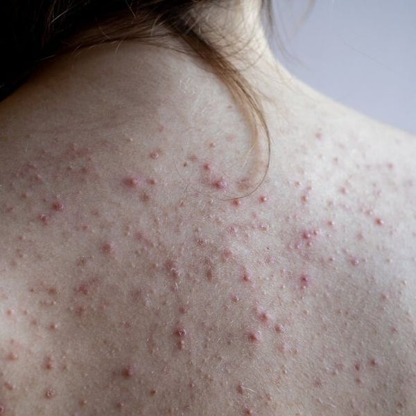 5 mjesta na tijelu gdje se mogu pojaviti akne i što učiniti u vezi s tim