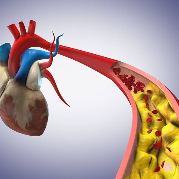 Ovu granicu kolesterola morate znati – smanjuje rizik od infarkta čak za 33 %!