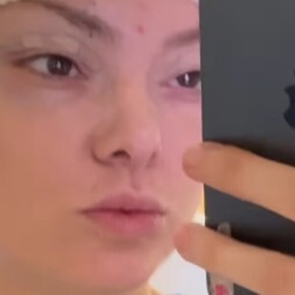 Ella Dvornik na Instagramu otkrila da je bila na estetskom zahvatu