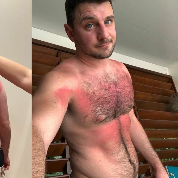 Nisu bili spremni za sunčanje, a posljedice boli i gledati