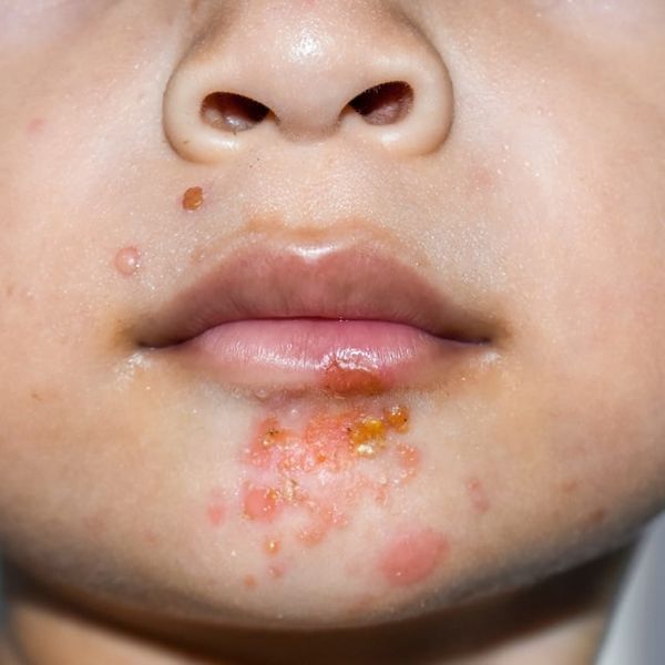 Impetigo: Prijenos, komplikacije i liječenje – sve je tu!
