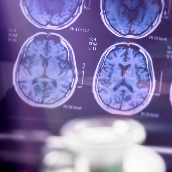 Neurolog otkriva brzi test za demenciju od tri pokreta koji može biti važan pokazatelj