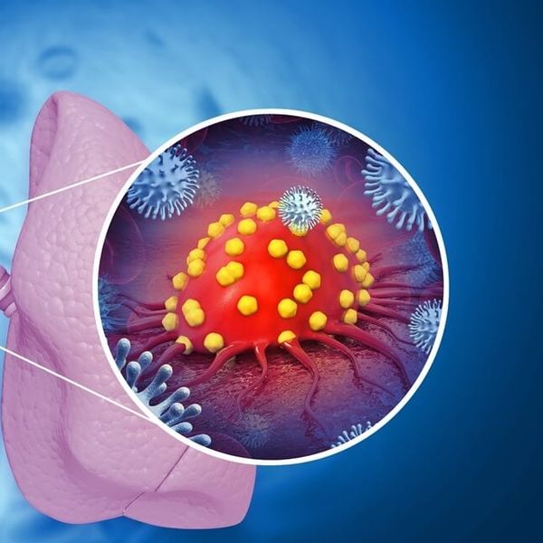 Tri puta više smrtnih slučajeva od raka pluća moglo bi se spriječiti ovim jednostavnim korakom!