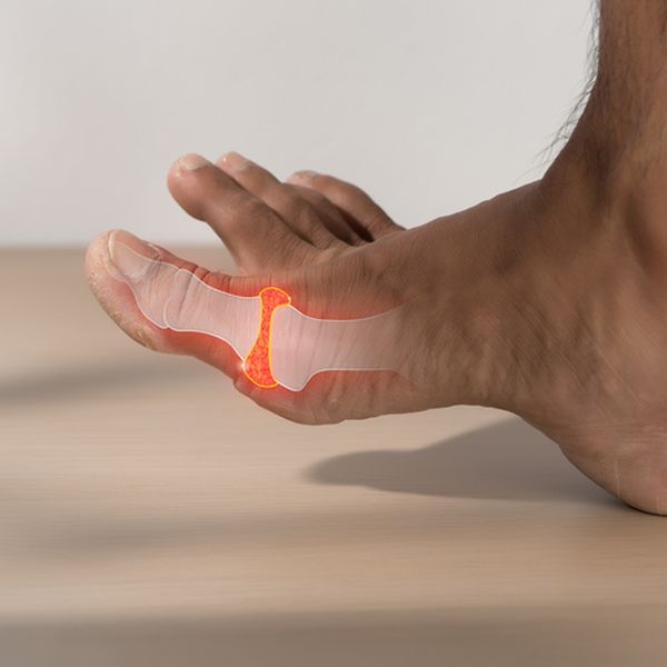 Jedno istraživanje mijenja sve što znamo o gihtu