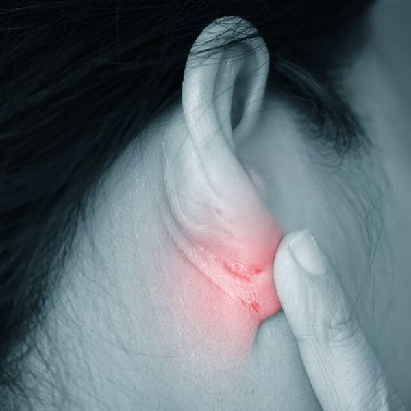 Dermatitis uha: Je li kriv nakit, slušalice ili gljivice? Evo kako prepoznati pravi uzrok!