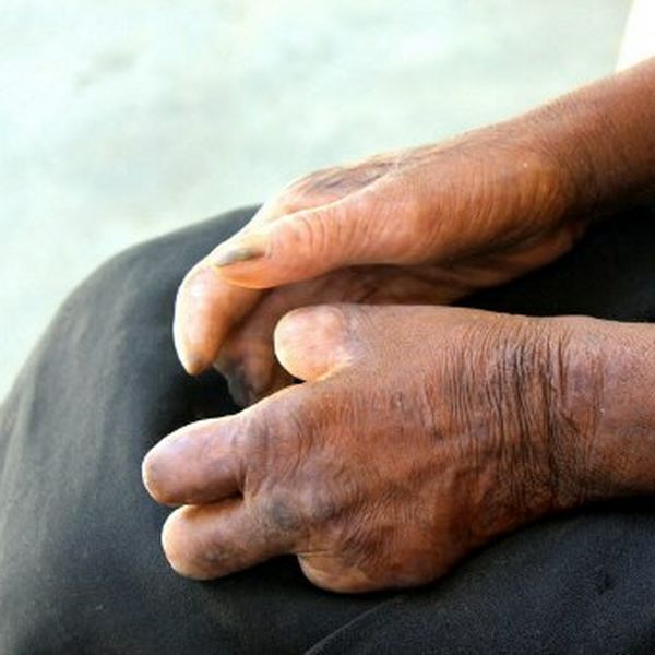 U Hrvatskoj potvrđen slučaj gube!