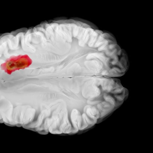 Znanstvenici šokirani: Stari lijek za tlak mogao bi usporiti jedan od najopasnijih tumora mozga!