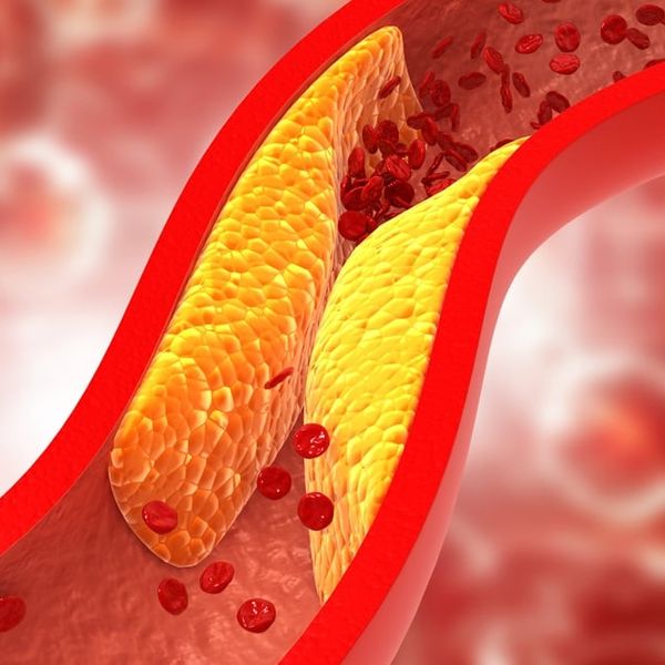 Plak u arterijama: Što ga uzrokuje i kako ga smanjiti?