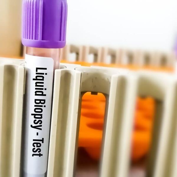 Tekuća biopsija: Jednostavna pretraga koja može otkriti rak bez invazivnih zahvata