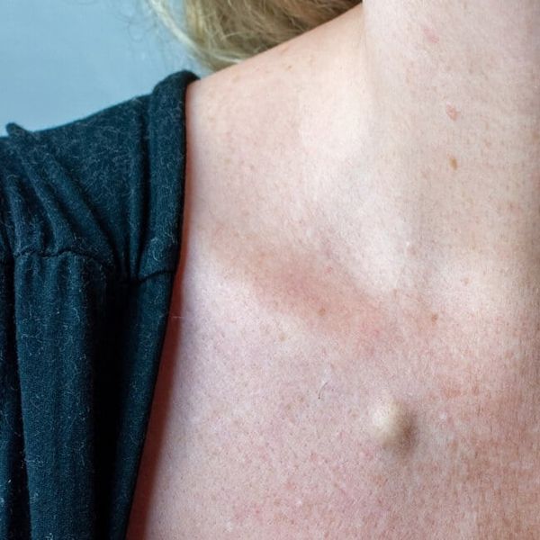 Ciste na koži: Zašto nastaju i kada ih je potrebno ukloniti?