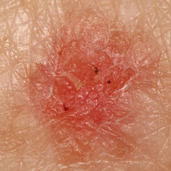 Karcinom in situ: Koje je značenje? Evo što trebate znati