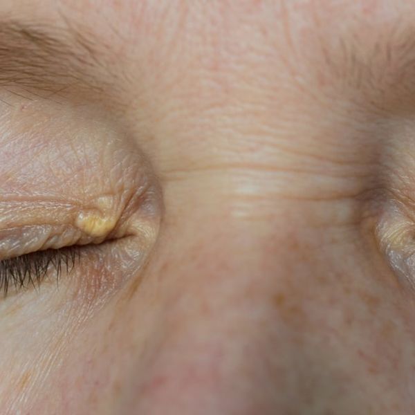 Simptomi bolesti jetre na koži: Ako imate neku od ovih 9 kožnih promjena, obavezno provjerite jetru!