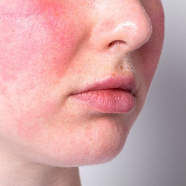 Zima i rozaceja: 6 pogrešaka koje vam crvene lice više nego ljetno sunce