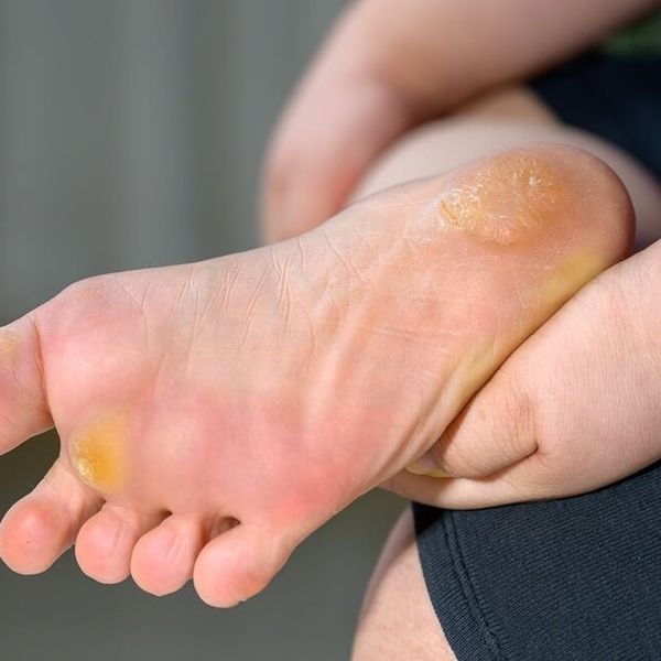 5 razloga zašto vam je koža na tabanima žuta (i kada morate što prije liječniku)