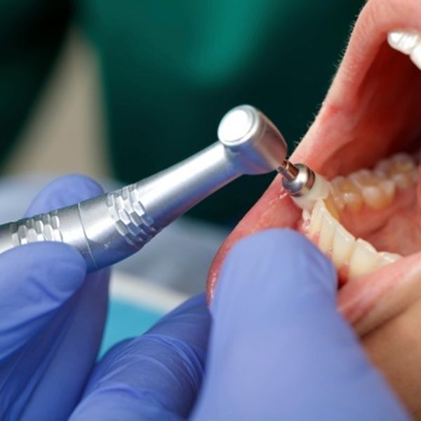 Od 1. srpnja novi materijali za ispune u okviru dentalne zdravstvene zaštite