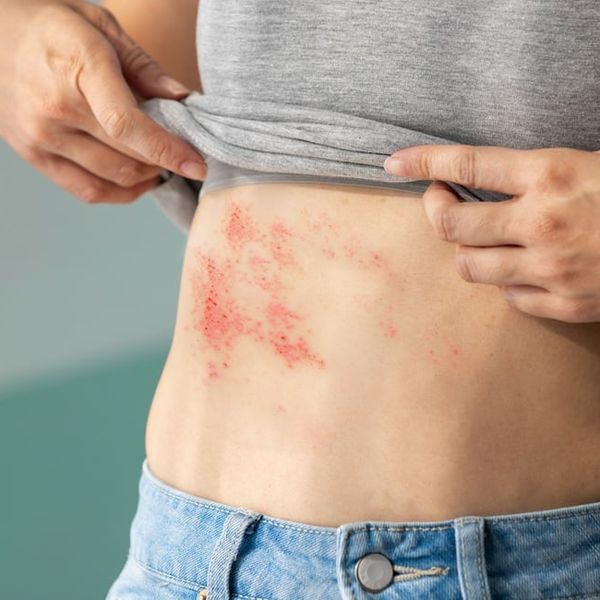 Većina ljudi ne zna ovo o herpes zosteru, a posljedice mogu trajati godinama