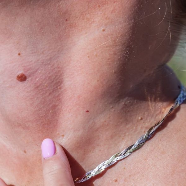 Simptomi raka kože: Ako primijetite ovih 7 promjena, javite se dermatologu