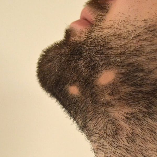 Alopecija brade: Zašto nastaje i može li se dlaka ponovno vratiti?