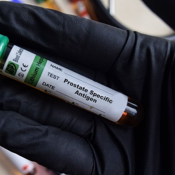 Novi test za rak prostate otkriva više opasnih slučajeva od PSA testa