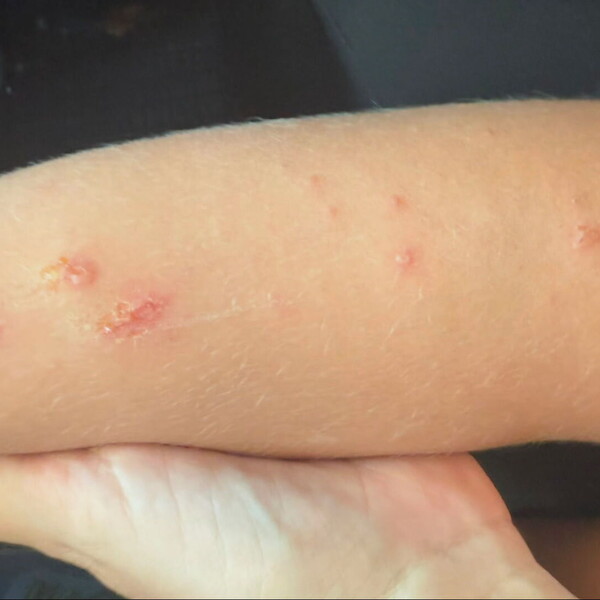 Što treba znati o impetigu koji se širi među djecom