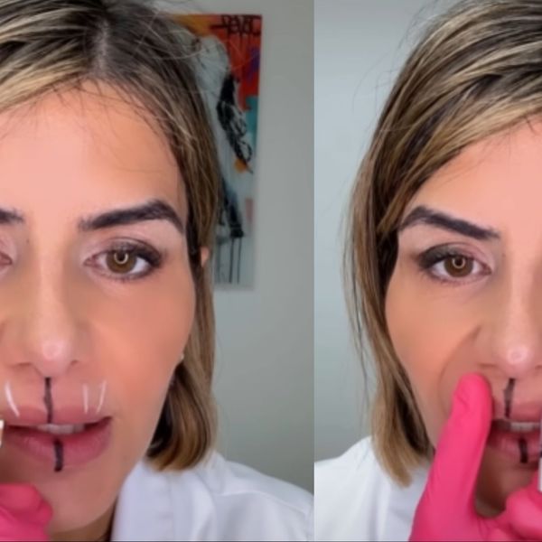 Liječnica ubrizgala botoks u jednu stranu lica i pokazala razliku!