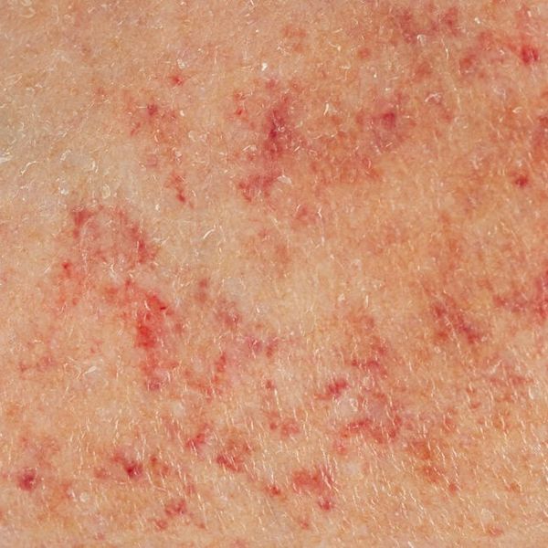 Meningokokna sepsa: Koji su simptomi bakterije koju nosi jedan od 10 ljudi?