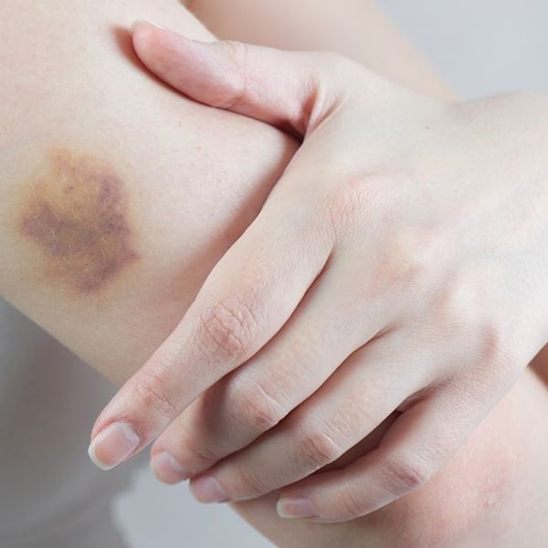 Modrice po tijelu mogu biti znak ozbiljne bolesti? Evo kada morate liječniku