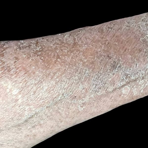Pelagra bolest: Nedostatak jednog vitamina može dovesti do demencije i ozbiljnih komplikacija