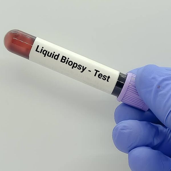 Tekuća biopsija: Krvna pretraga koja pomaže u ranijem otkrivanju raka pluća