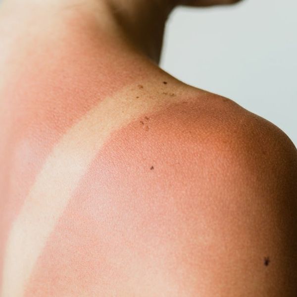Zašto neki ljudi izgore na suncu već nakon 15 minuta, a drugi ne?