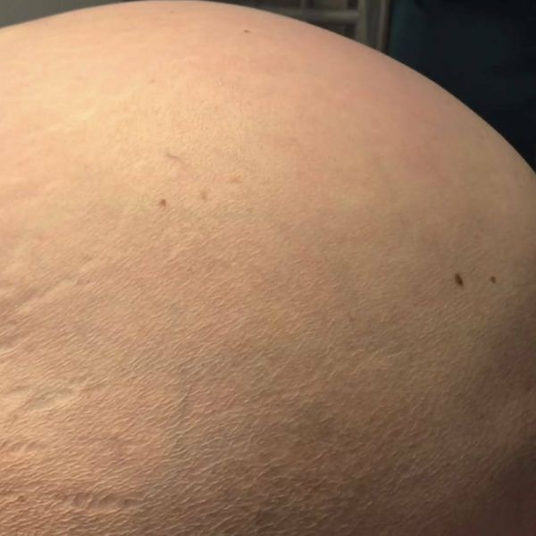 Liječnički tim gospićke bolnice odstranio tumor težak 36 kilograma