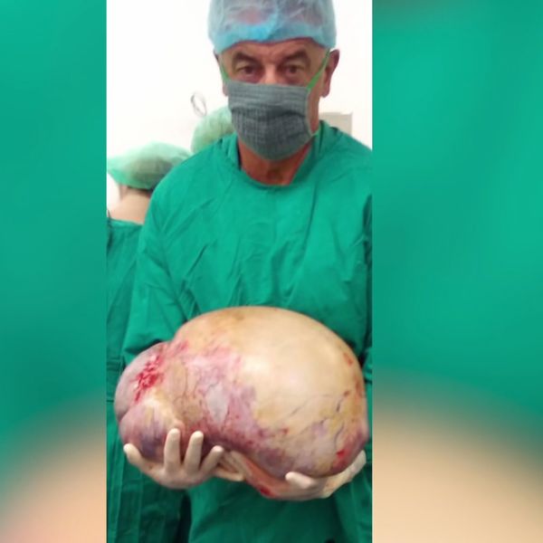 Veliki uspjeh: Pacijentici iz Gospića uklonjen tumor težak 36 kilograma!