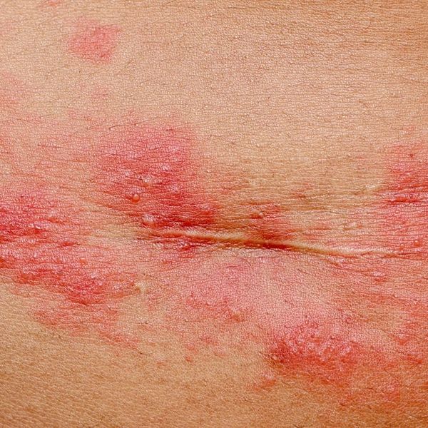 Herpes zoster ispod grudi: Ovo su prvi znakovi koje žene najčešće ignoriraju