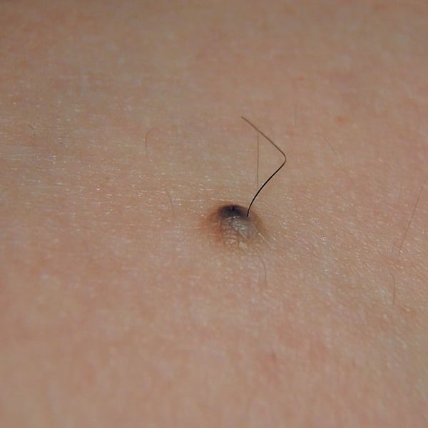 Raste li vam dlaka iz madeža? Evo što to zapravo znači (i kada je opasno!)