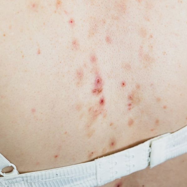 Mehaničke akne: Ove akne nemaju veze s hormonima – evo što ih zapravo uzrokuje i kako se liječe