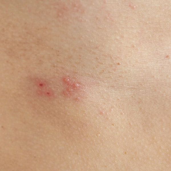 Herpes zoster prijeti ovim ljudima: Jeste li među rizičnim skupinama?